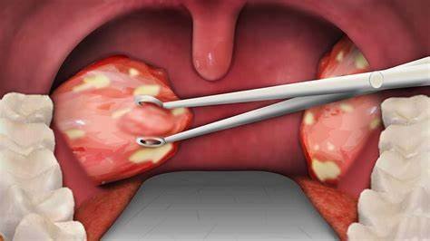 can tonsils grow back after being removed? - tymoff